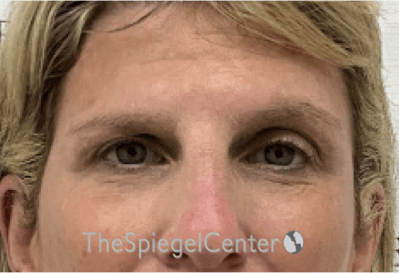 Temple Filler Before & After Gallery - Patient 326430 - Image 2