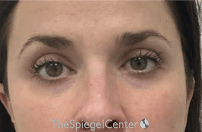 Temple Filler Before & After Gallery - Patient 250840 - Image 1