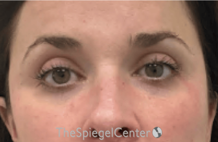 Temple Filler Before & After Gallery - Patient 250840 - Image 2