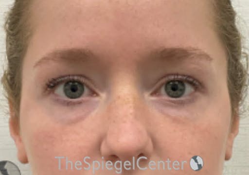 Temple Filler Before & After Gallery - Patient 888482 - Image 1