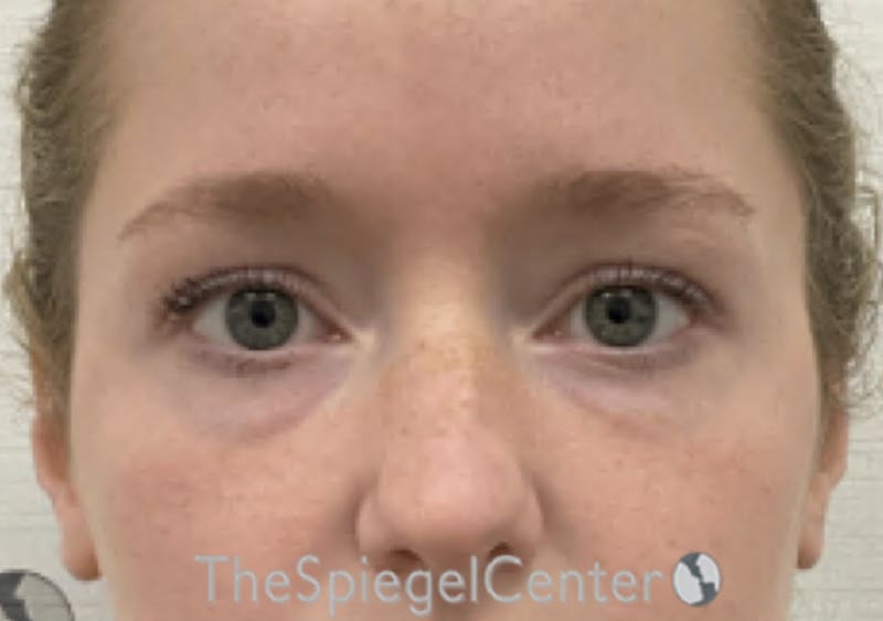Temple Filler Before & After Gallery - Patient 888482 - Image 1