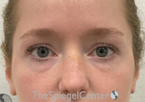 Temple Filler Before & After Gallery - Patient 888482 - Image 1
