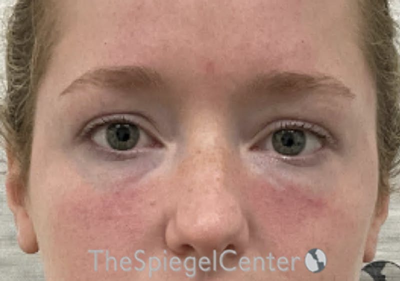 Temple Filler Before & After Gallery - Patient 888482 - Image 2