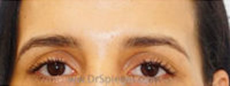 Temple Filler Before & After Gallery - Patient 374796 - Image 1