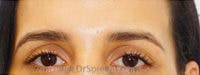Temple Filler Before & After Gallery - Patient 374796 - Image 1