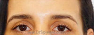 Temple Filler Before & After Gallery - Patient 374796 - Image 1