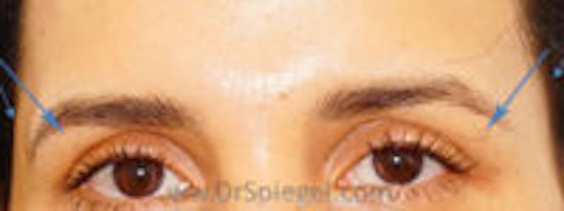 Temple Filler Before & After Gallery - Patient 374796 - Image 2