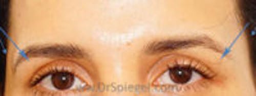 Temple Filler Before & After Gallery - Patient 374796 - Image 2