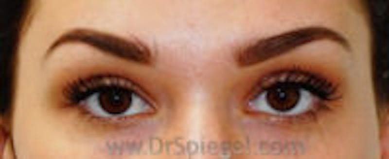 Temple Filler Before & After Gallery - Patient 107586 - Image 1