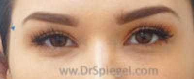 Temple Filler Before & After Gallery - Patient 107586 - Image 2