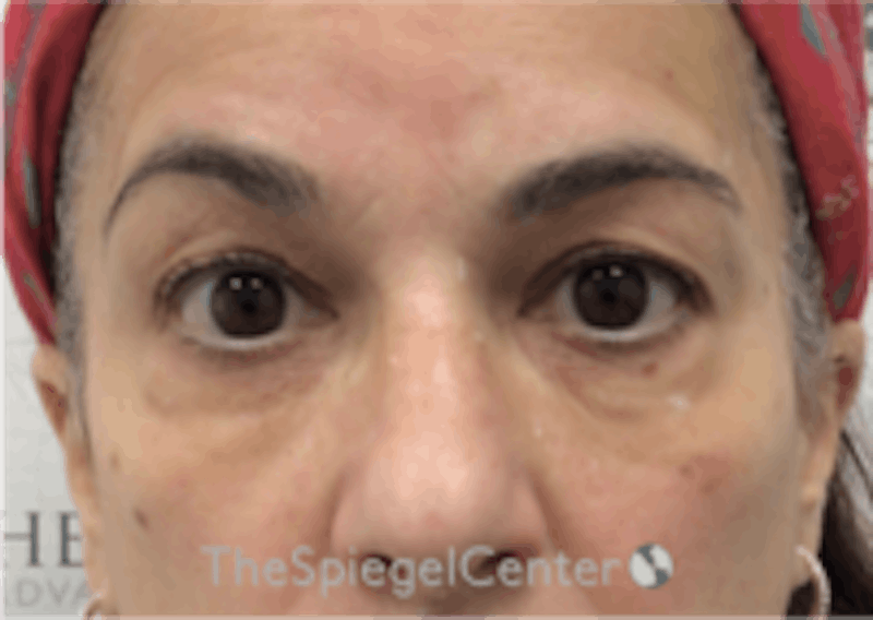 Temple Filler Before & After Gallery - Patient 348931 - Image 1