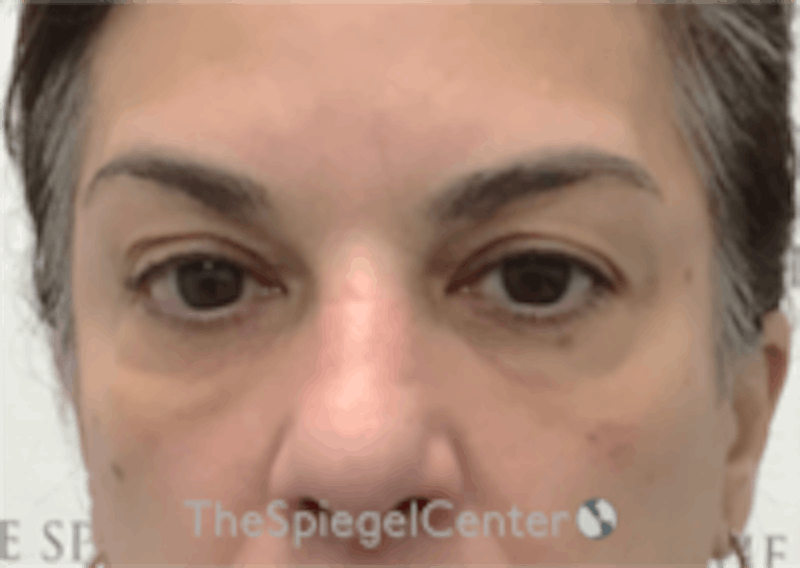 Temple Filler Before & After Gallery - Patient 348931 - Image 2
