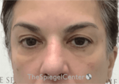 Temple Filler Before & After Gallery - Patient 348931 - Image 2