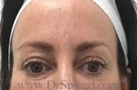 Temple Filler Before & After Gallery - Patient 248683 - Image 1