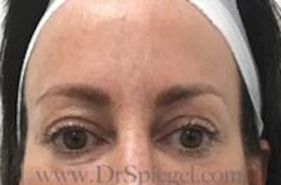 Temple Filler Before & After Gallery - Patient 248683 - Image 1