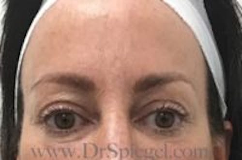 Temple Filler Before & After Gallery - Patient 248683 - Image 1