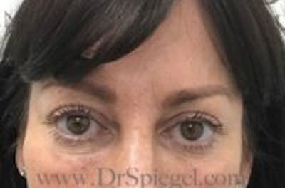 Temple Filler Before & After Gallery - Patient 248683 - Image 2