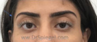 Temple Filler Before & After Gallery - Patient 257906 - Image 1