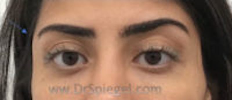 Temple Filler Before & After Gallery - Patient 257906 - Image 2