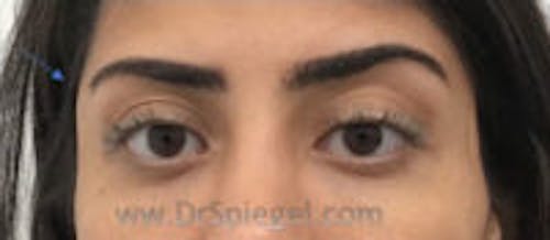 Temple Filler Before & After Gallery - Patient 257906 - Image 2