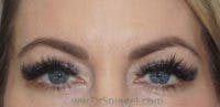 Temple Filler Before & After Gallery - Patient 813198 - Image 1