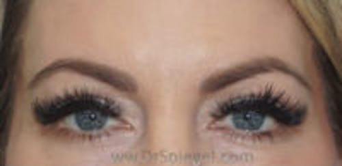 Temple Filler Before & After Gallery - Patient 813198 - Image 1