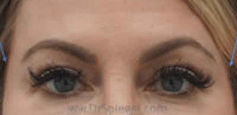 Temple Filler Before & After Gallery - Patient 813198 - Image 2