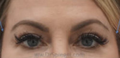 Temple Filler Before & After Gallery - Patient 813198 - Image 2
