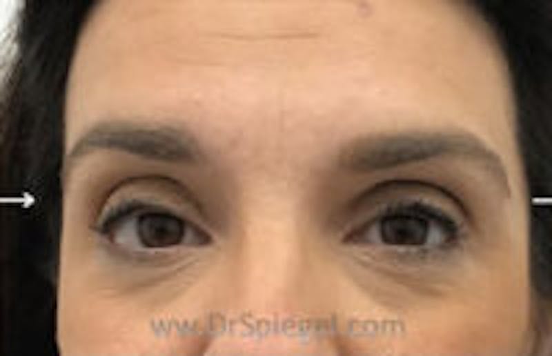 Temple Filler Before & After Gallery - Patient 146049 - Image 1