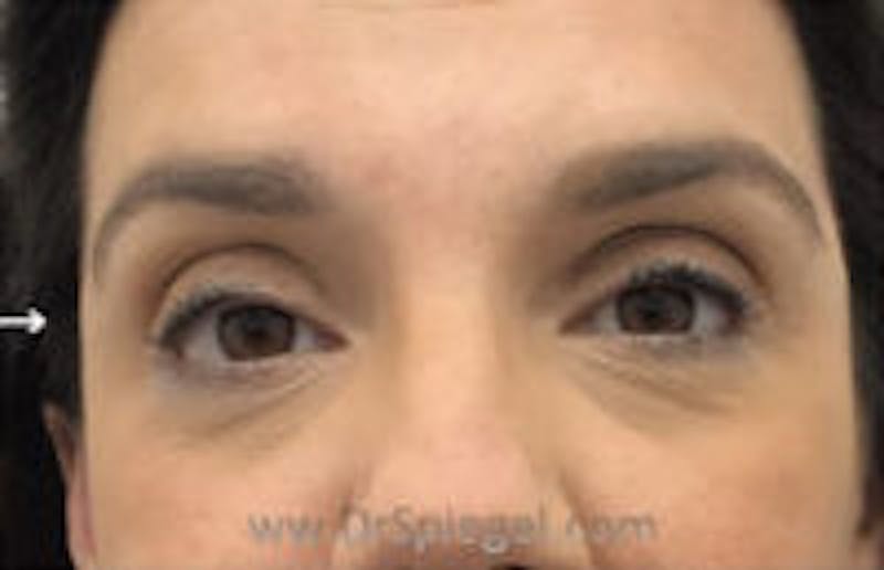 Temple Filler Before & After Gallery - Patient 146049 - Image 2