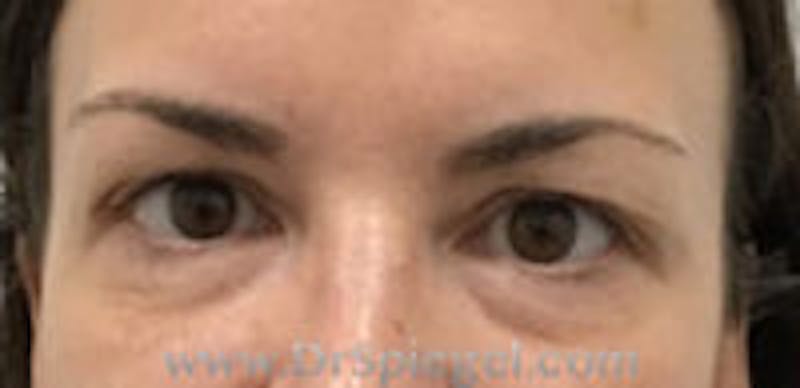 Temple Filler Before & After Gallery - Patient 133526 - Image 1