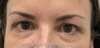 Temple Filler Before & After Gallery - Patient 133526 - Image 1