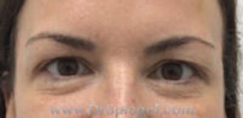 Temple Filler Before & After Gallery - Patient 133526 - Image 2