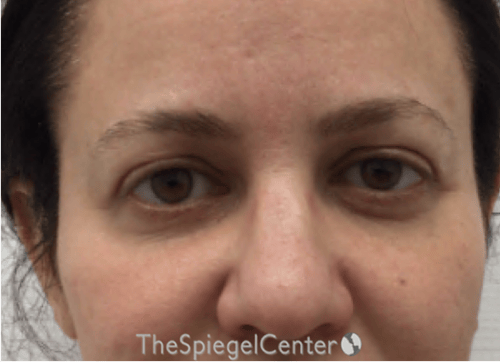 Temple Filler Before & After Gallery - Patient 101645 - Image 1
