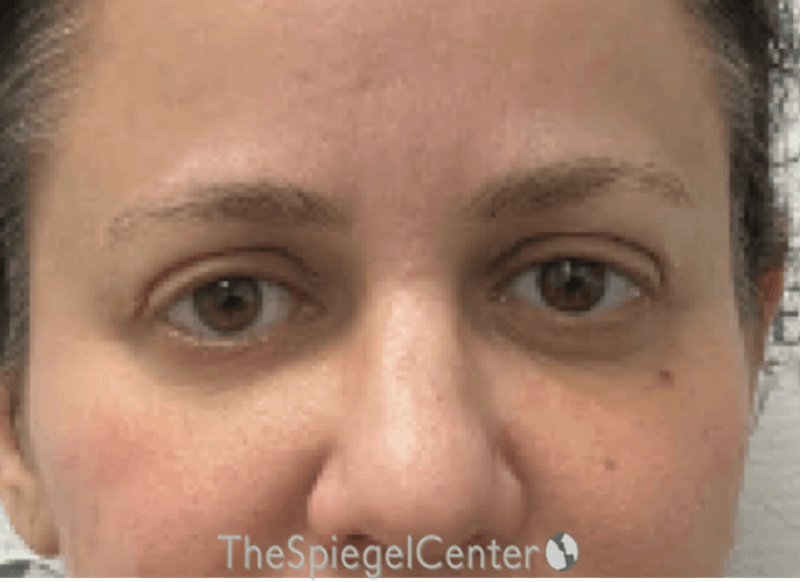 Temple Filler Before & After Gallery - Patient 101645 - Image 2