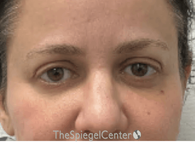 Temple Filler Before & After Gallery - Patient 101645 - Image 2