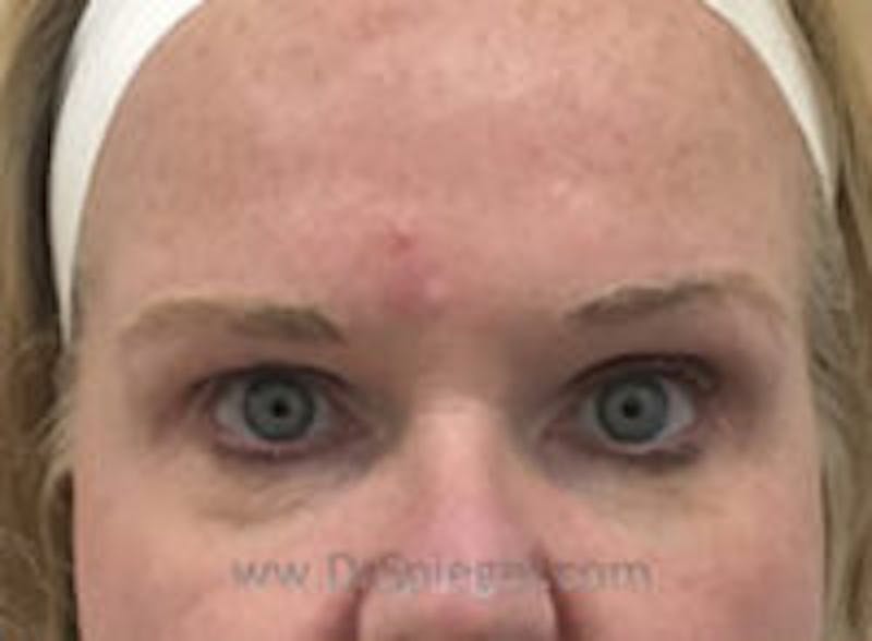 Temple Filler Before & After Gallery - Patient 126034 - Image 1