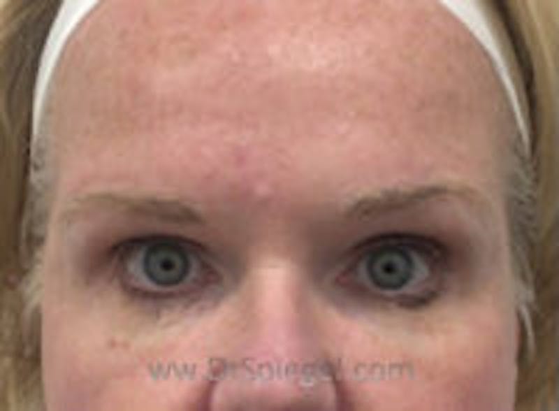 Temple Filler Before & After Gallery - Patient 126034 - Image 2