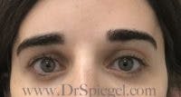 Temple Filler Before & After Gallery - Patient 382067 - Image 1