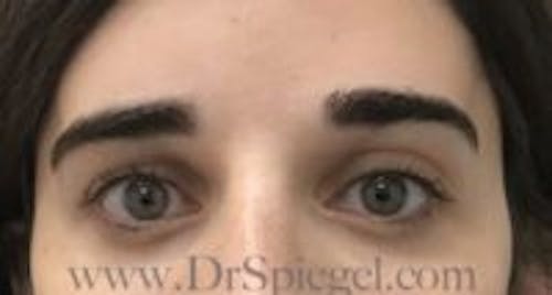 Temple Filler Before & After Gallery - Patient 382067 - Image 1