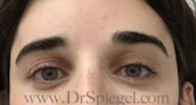 Temple Filler Before & After Gallery - Patient 382067 - Image 2