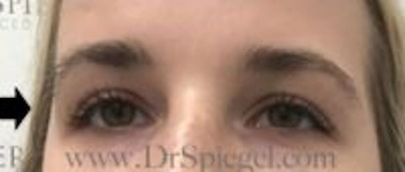 Temple Filler Before & After Gallery - Patient 110176 - Image 1