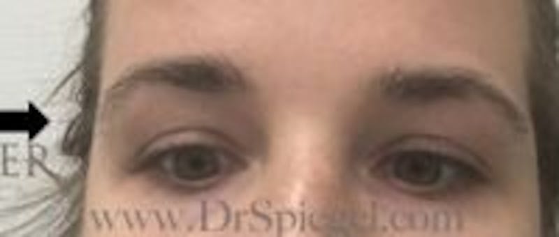 Temple Filler Before & After Gallery - Patient 110176 - Image 2