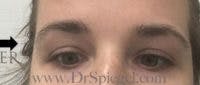 Temple Filler Before & After Gallery - Patient 110176 - Image 2