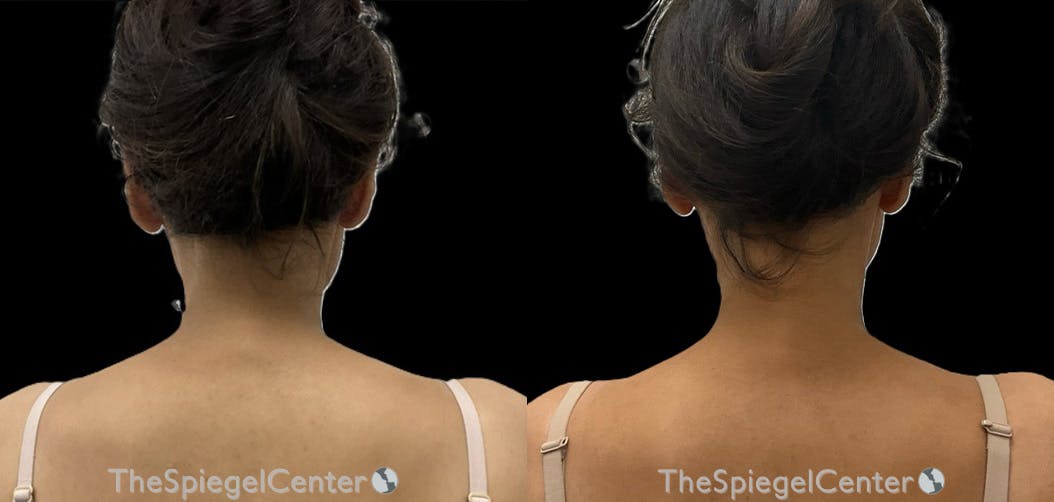 Trapezius Botox (TrapTox) Before & After Gallery - Patient 287558 - Image 1