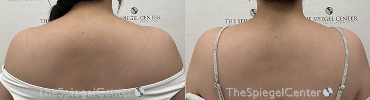 Trapezius Botox (TrapTox) Before & After Gallery - Patient 214145 - Image 1