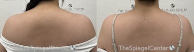 Trapezius Botox (TrapTox) Before & After Gallery - Patient 214145 - Image 1