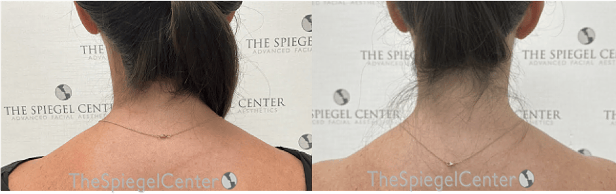 Trapezius Botox (TrapTox) Before & After Gallery - Patient 132699 - Image 1