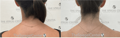 Trapezius Botox (TrapTox) Before & After Gallery - Patient 132699 - Image 1