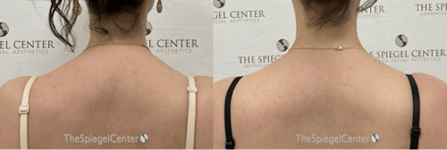 Trapezius Botox (TrapTox) Before & After Gallery - Patient 239580 - Image 1